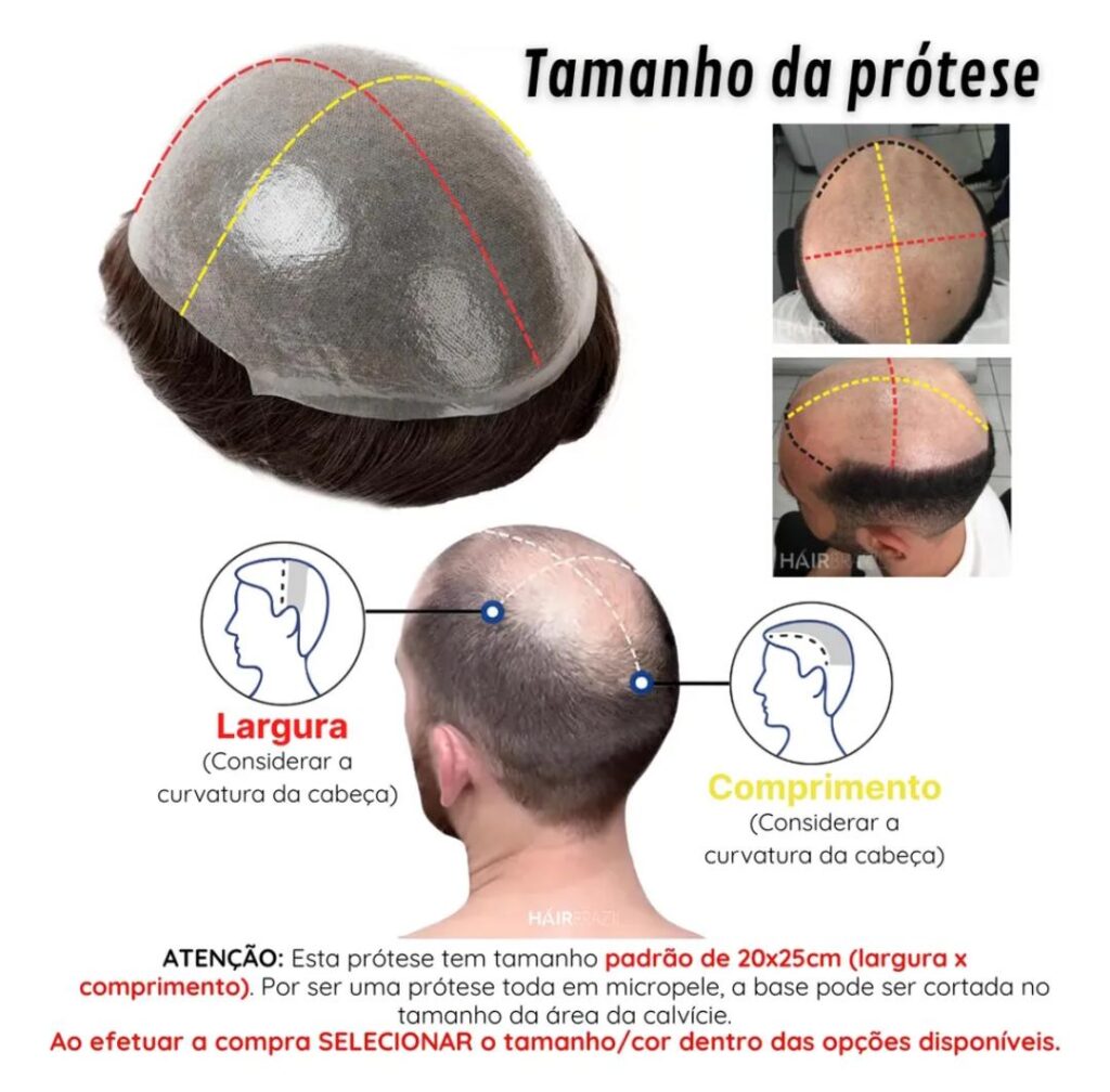Prótese capilar